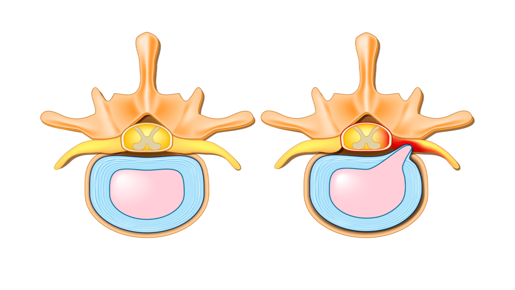 can-cervical-foraminal-stenosis-affect-gait-and-leg-weakness-e